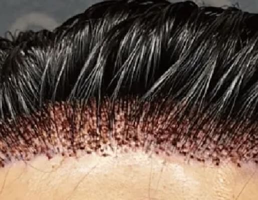 かさぶたの経過と注意点