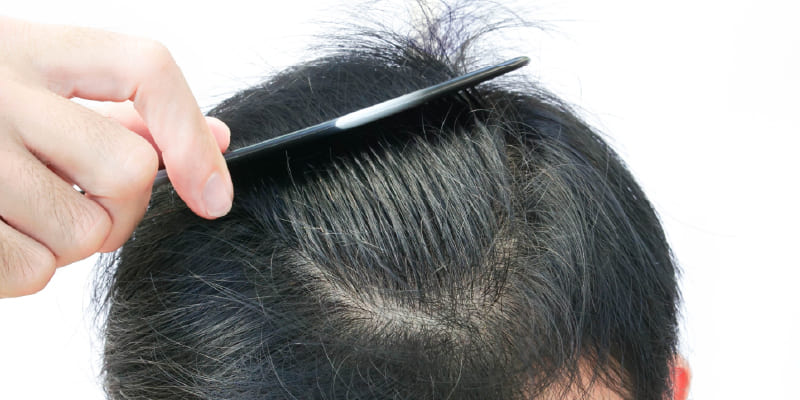 植毛はなぜ薄毛部位に定着するのか