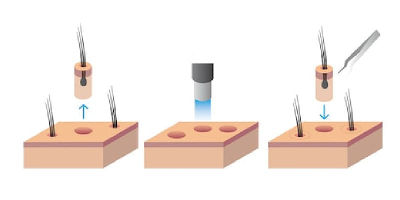 移植毛が定着する仕組み