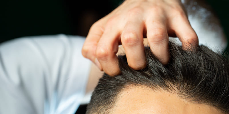 植毛の生着率とは？