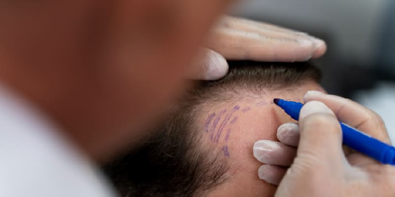 生着率を高めるための施術技術