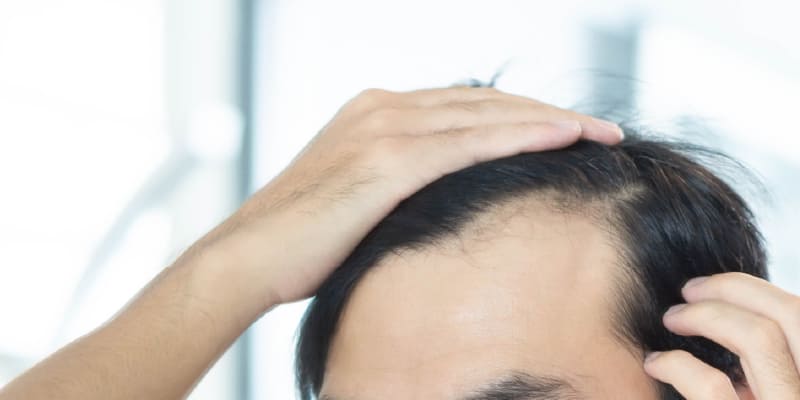 植毛の定着がうまくいかなかったケース