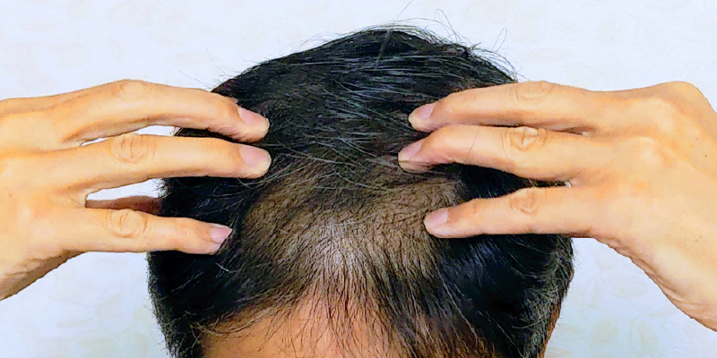 AGAによる若年型薄毛の特徴