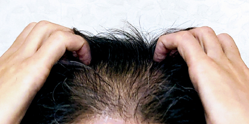 若ハゲは早期発見と対策がカギ