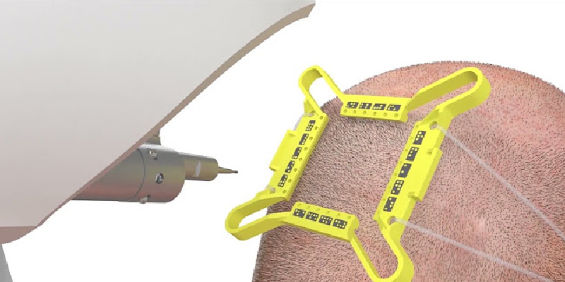 植毛用ロボット・AI支援技術の導入