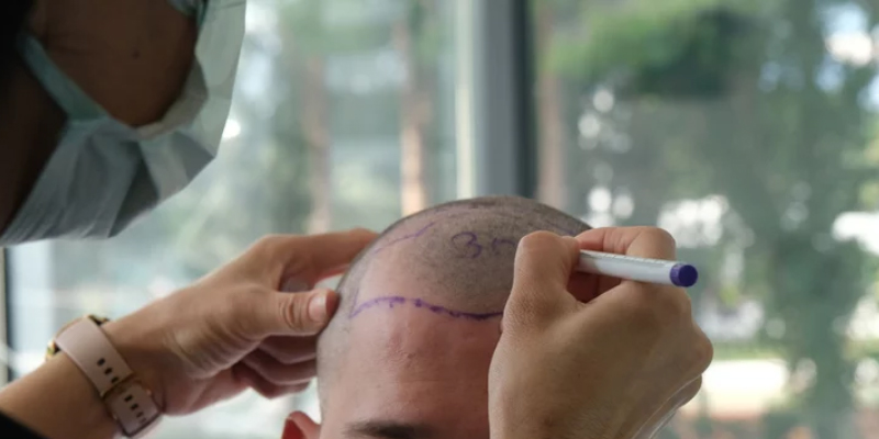 トルコ植毛最新技術を活用する際の注意点