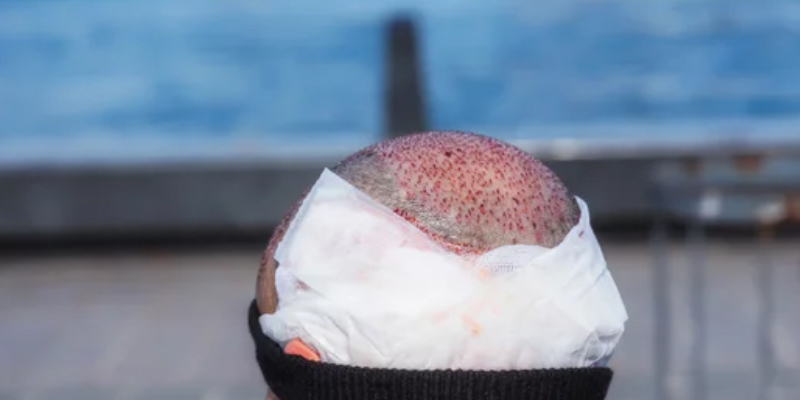 術後数日間の痛み・不快感