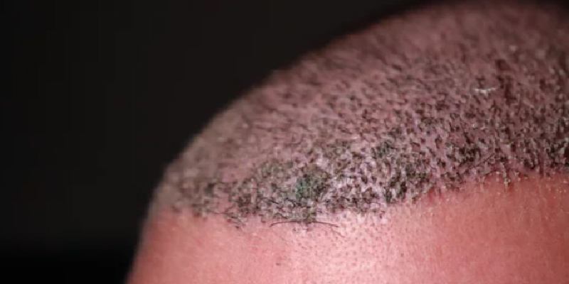 手術後1週間以降の経過