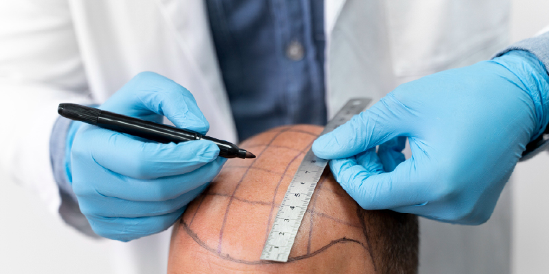 植毛前は準備段階がとても重要