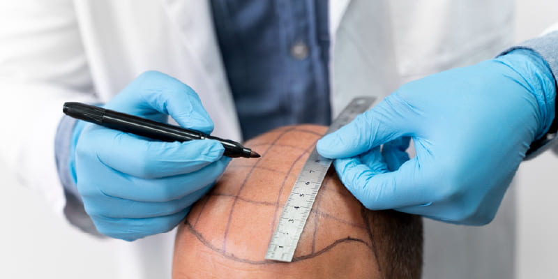 植毛はクリニック選びが成否を左右する