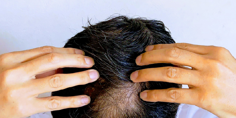 日本人男性の薄毛はどのくらいの割合で発症しているのか？