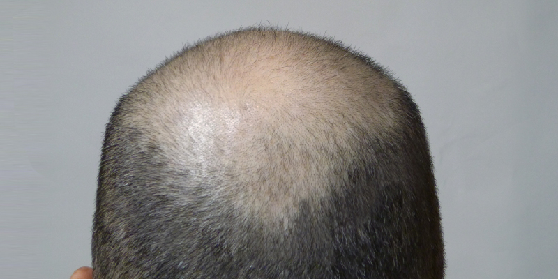 日本人男性のAGA発症の特徴