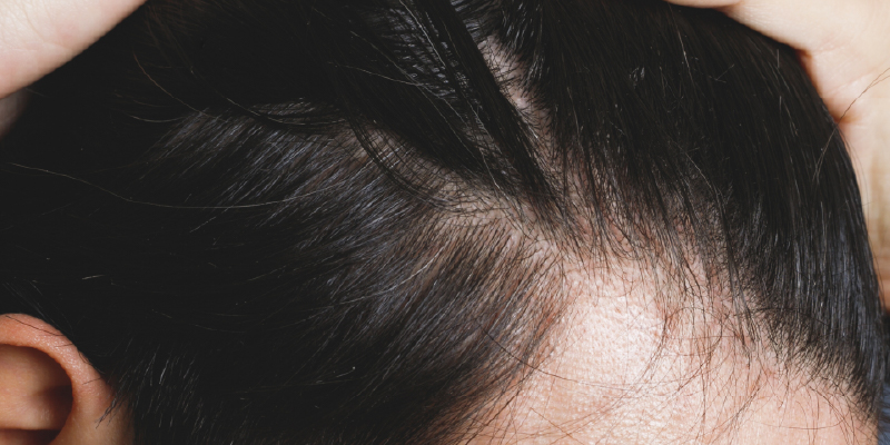 M字型（生え際後退）の治療方針