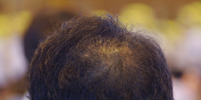 O字型（頭頂部薄毛）の治療方針