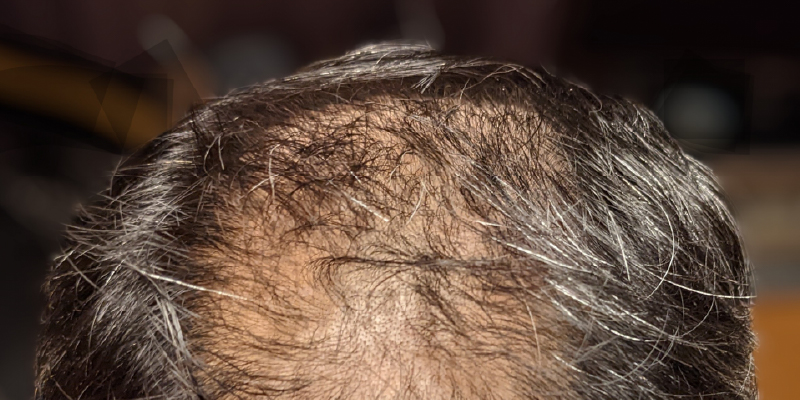 混合型（全体進行型）の治療方針