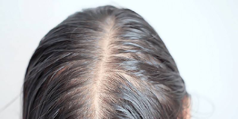 びまん性脱毛症は植毛適応外になるケースも