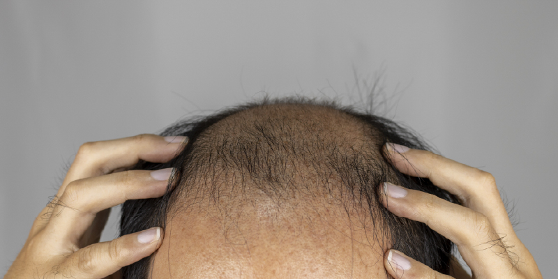 重度進行型は国内植毛が難しい理由