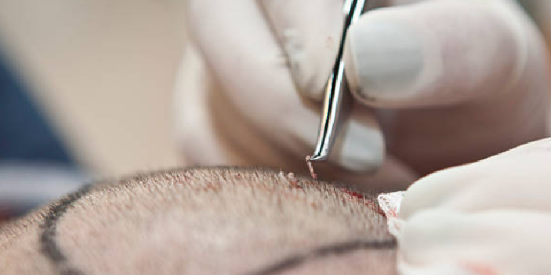 トルコ植毛の料金体系とは？