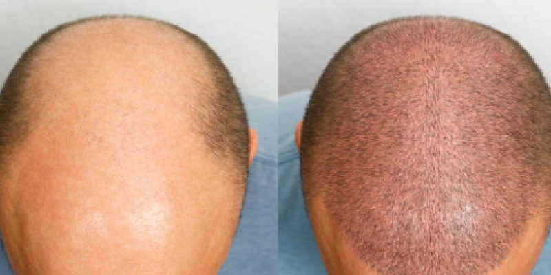 大量移植で生じる総額差