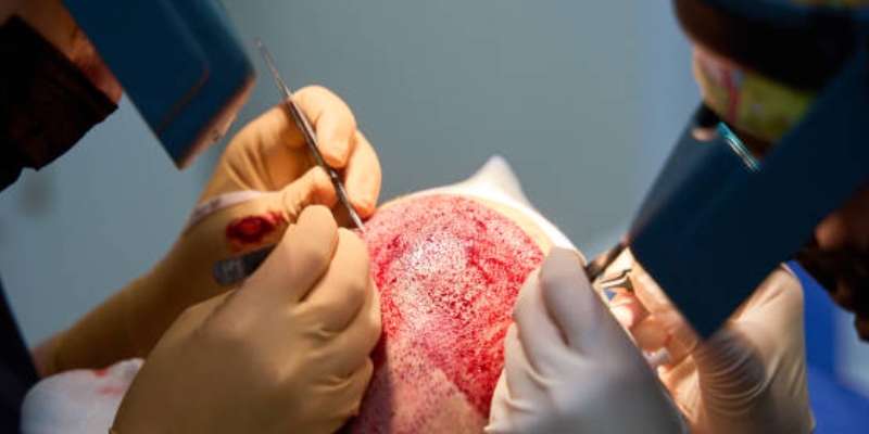 インプランター技術の完成度