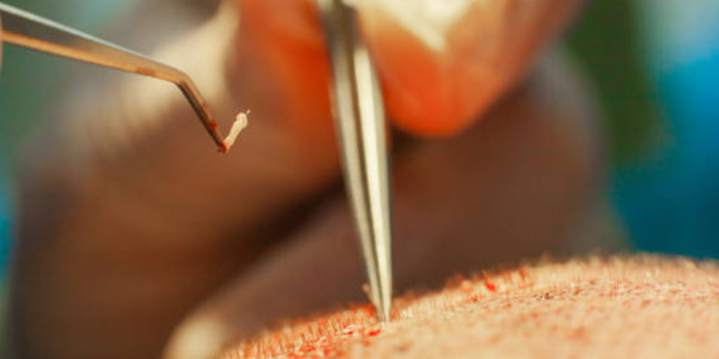 密度が高いほど再施術リスクも減る