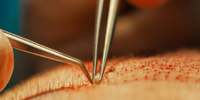 移植部（レシピエント部）の定着限界