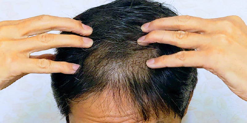 自毛植毛は何歳から受けられるのか？