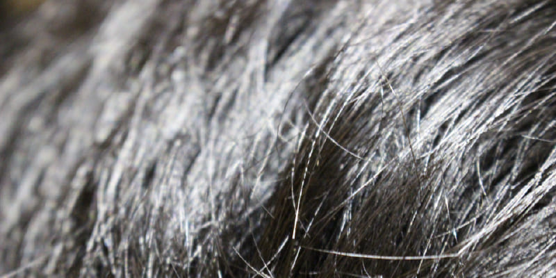 若年で植毛する際のリスクと注意点