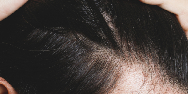 生え際が不自然だと全て台無しになる理由