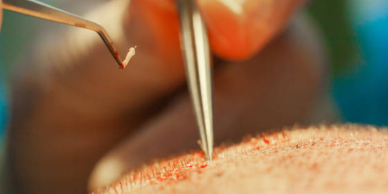 植え込む角度と方向がデザイン精度を左右する