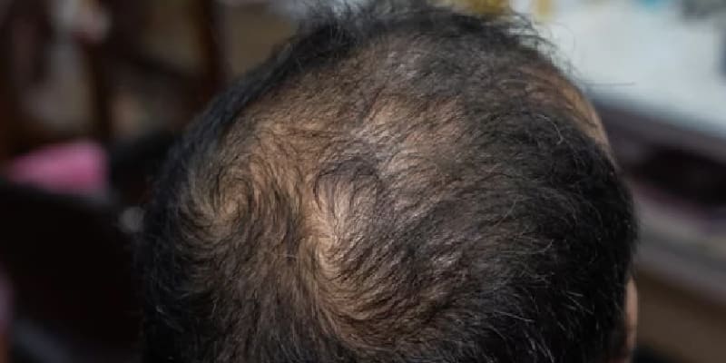 自毛植毛にも失敗リスクは存在する