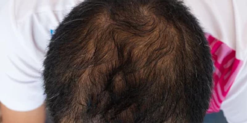 よくある自毛植毛の失敗例