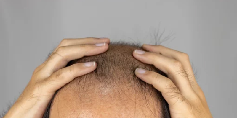 植毛が適応外となるケースとは