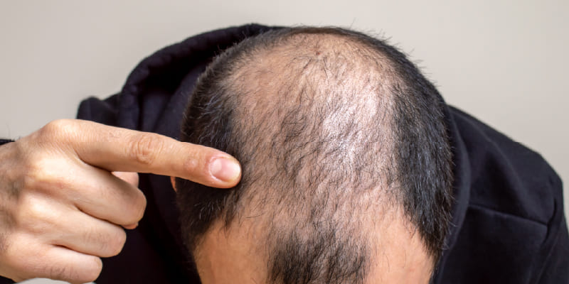 植毛はAGAそのものを治す治療ではない