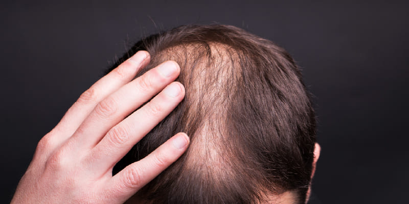 植毛後もAGAが進行する理由