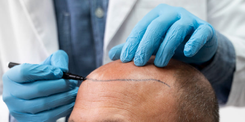 トルコ植毛の年間症例数はどのくらい？