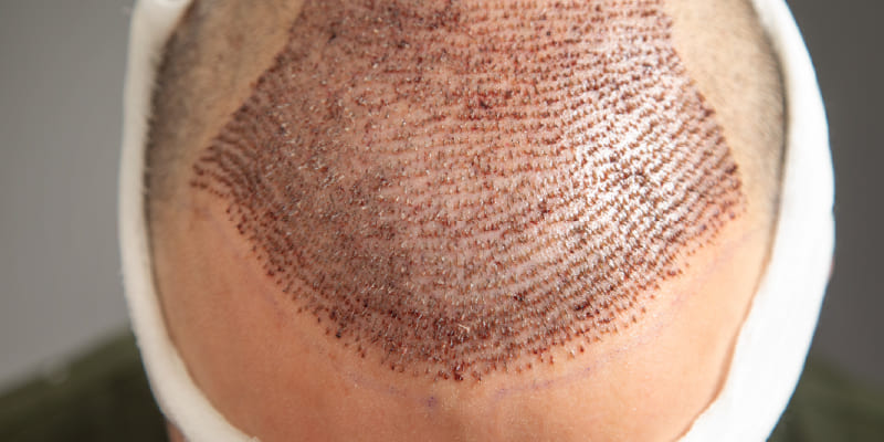 トルコ植毛のメリットと注意点