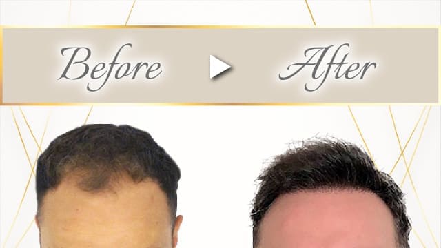 植毛施術事例