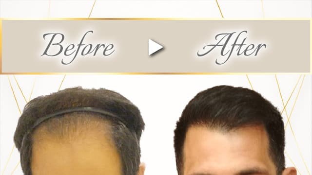 植毛施術事例