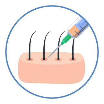 局所麻酔の実施