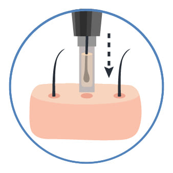DHIインプランターを用いた直接移植