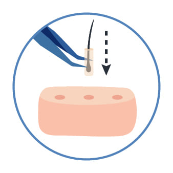毛根の丁寧な移植