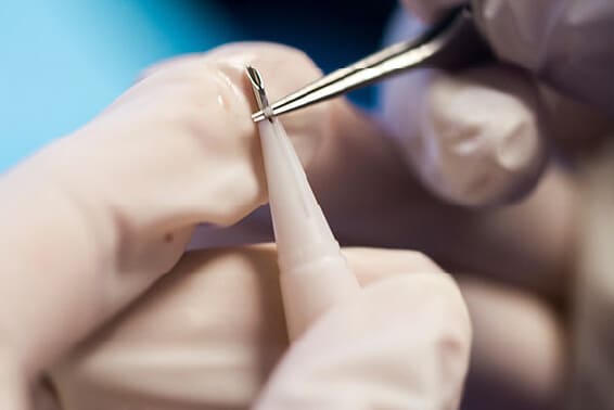 坊主にしないDHI植毛で施術可能