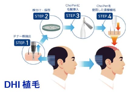DHI植毛プラン