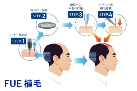FUE植毛プラン