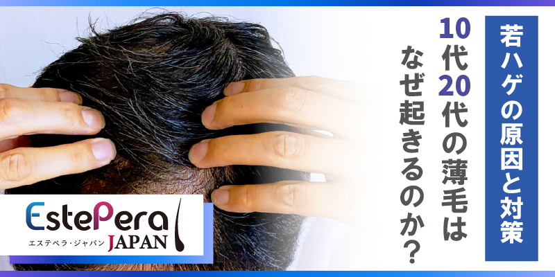 『若ハゲの原因と対策』10代・20代の薄毛はなぜ起きるのか