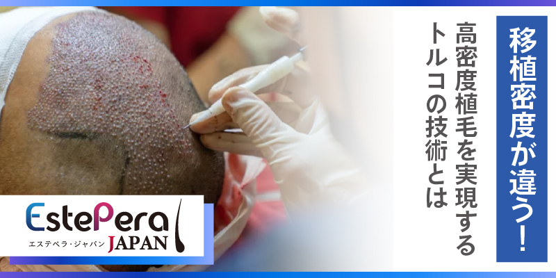 移植密度が違う！高密度植毛を実現するトルコの技術とは